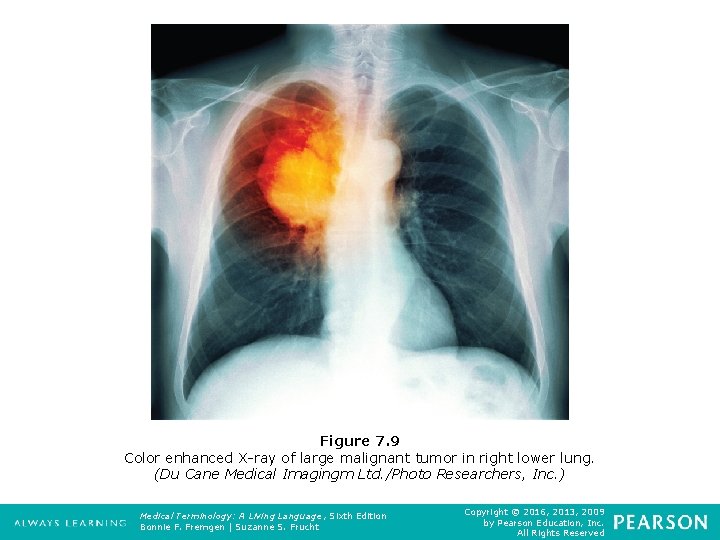 Figure 7. 9 Color enhanced X-ray of large malignant tumor in right lower lung.