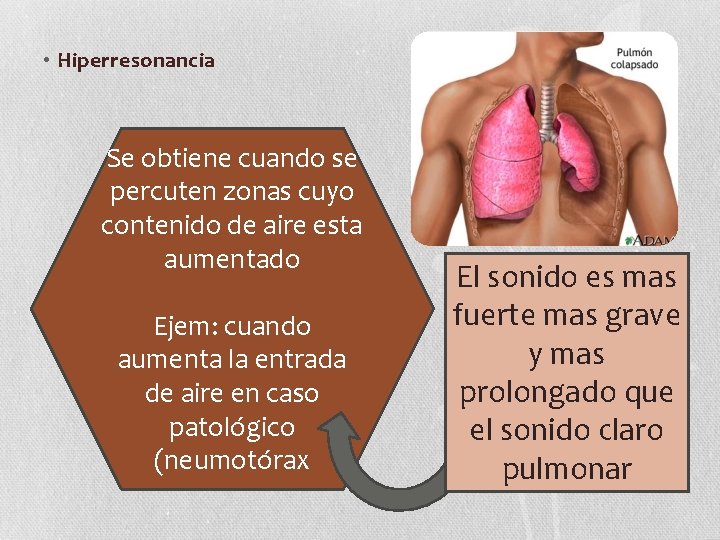  • Hiperresonancia Se obtiene cuando se percuten zonas cuyo contenido de aire esta