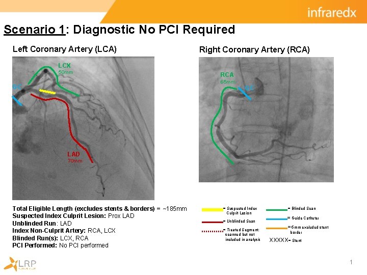 Scenario 1: Diagnostic No PCI Required Left Coronary Artery (LCA) Right Coronary Artery (RCA)