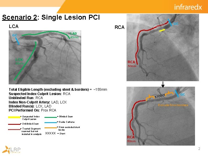 Scenario 2: Single Lesion PCI LCA GC RCA LAD GC 45 mm LCX RCA