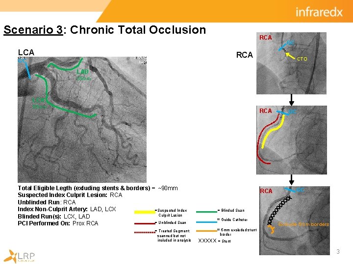 Scenario 3: Chronic Total Occlusion RCA LCA GC RCA GC CTO LAD 35 mm