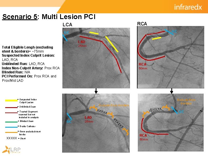 Scenario 5: Multi Lesion PCI RCA LCA GC GC LAD 25 mm Total Eligible