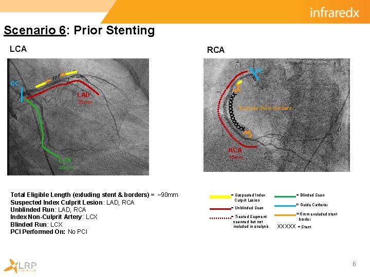 Scenario 6: Prior Stenting LCA GC RCA GC X XX LAD 35 mm Exclude