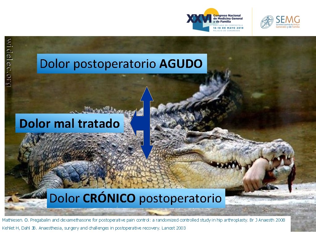 Dolor postoperatorio AGUDO Dolor mal tratado Dolor CRÓNICO postoperatorio Mathiesen. O. Pregabalin and dexamethasone Dolor postoperatorio AGUDO Dolor mal tratado Dolor CRÓNICO postoperatorio Mathiesen. O. Pregabalin and dexamethasone