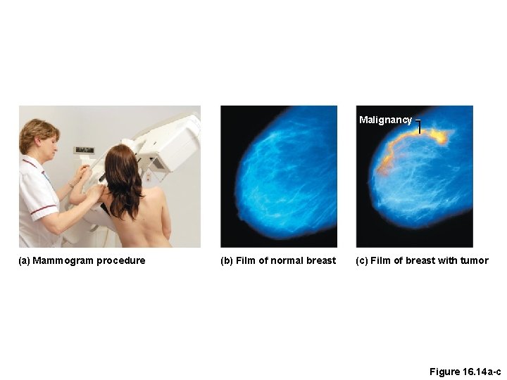 Malignancy (a) Mammogram procedure (b) Film of normal breast (c) Film of breast with
