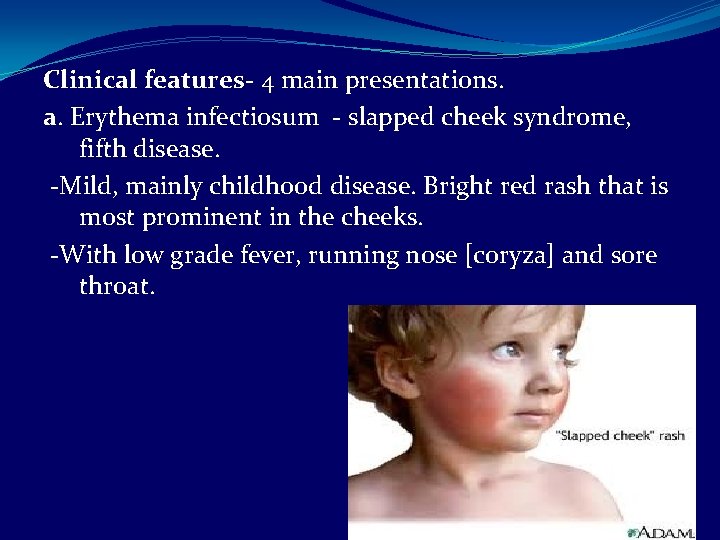Clinical features- 4 main presentations. a. Erythema infectiosum - slapped cheek syndrome, fifth disease.