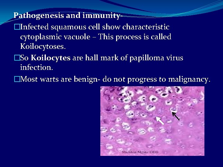 Pathogenesis and immunity�Infected squamous cell show characteristic cytoplasmic vacuole – This process is called