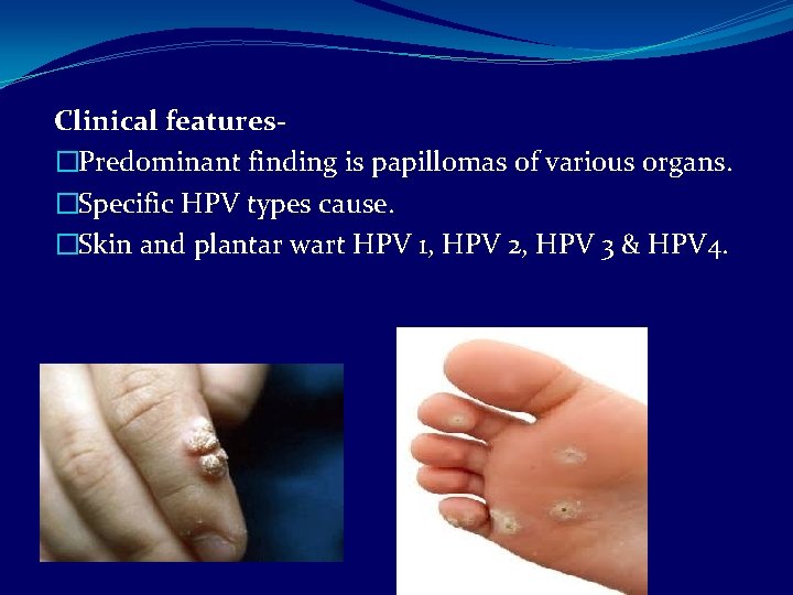 Clinical features�Predominant finding is papillomas of various organs. �Specific HPV types cause. �Skin and