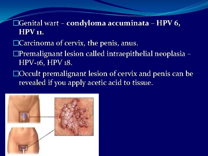 �Genital wart – condyloma accuminata – HPV 6, HPV 11. �Carcinoma of cervix, the