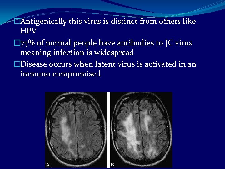 �Antigenically this virus is distinct from others like HPV � 75% of normal people