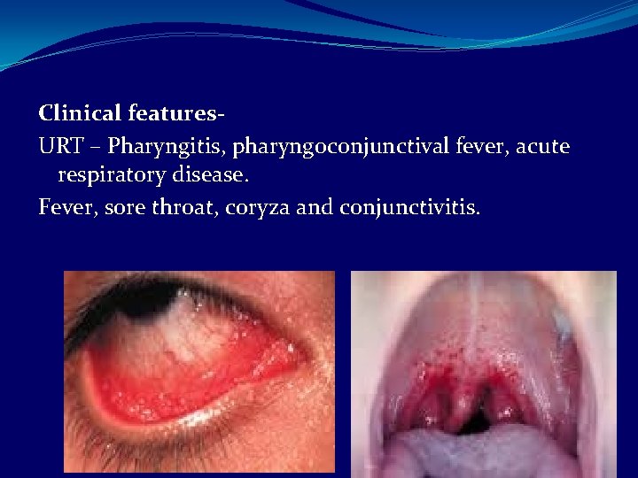 Clinical features. URT – Pharyngitis, pharyngoconjunctival fever, acute respiratory disease. Fever, sore throat, coryza