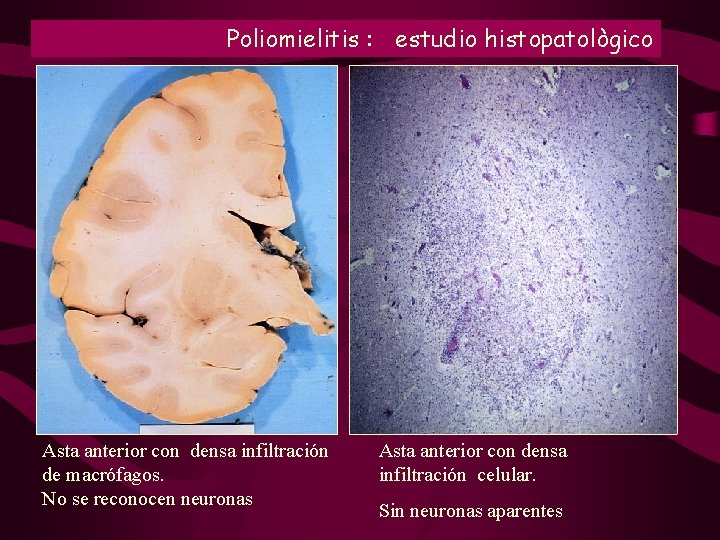 Poliomielitis : estudio histopatològico Asta anterior con densa infiltración de macrófagos. No se reconocen