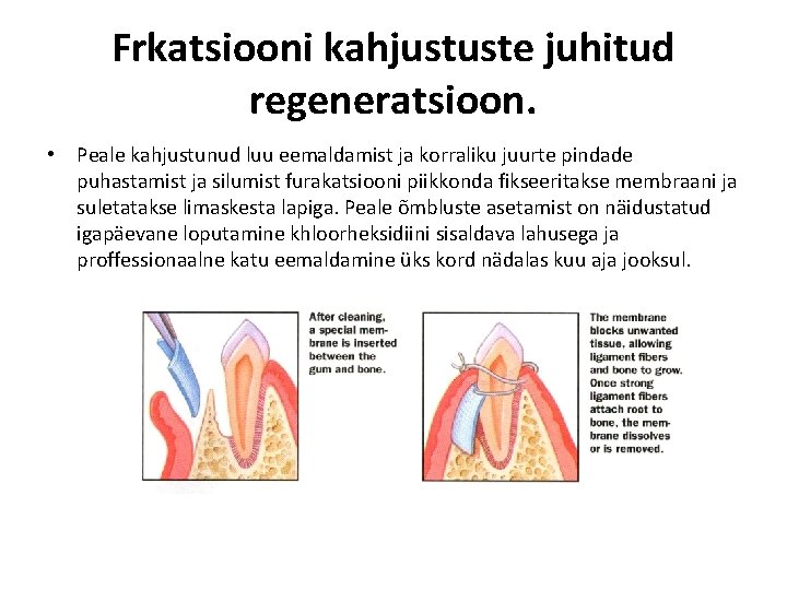 Frkatsiooni kahjustuste juhitud regeneratsioon. • Peale kahjustunud luu eemaldamist ja korraliku juurte pindade puhastamist