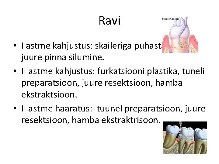 Ravi • I astme kahjustus: skaileriga puhastamine, juure pinna silumine. • II astme kahjustus: