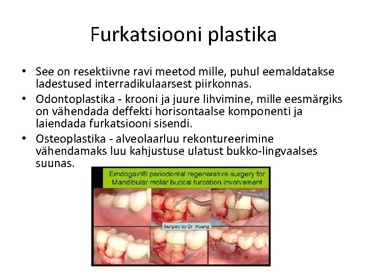 Furkatsiooni plastika • See on resektiivne ravi meetod mille, puhul eemaldatakse ladestused interradikulaarsest piirkonnas.