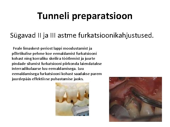 Tunneli preparatsioon Sügavad II ja III astme furkatsioonikahjustused. Peale limaskest-periost lappi moodustamist ja põletikulise