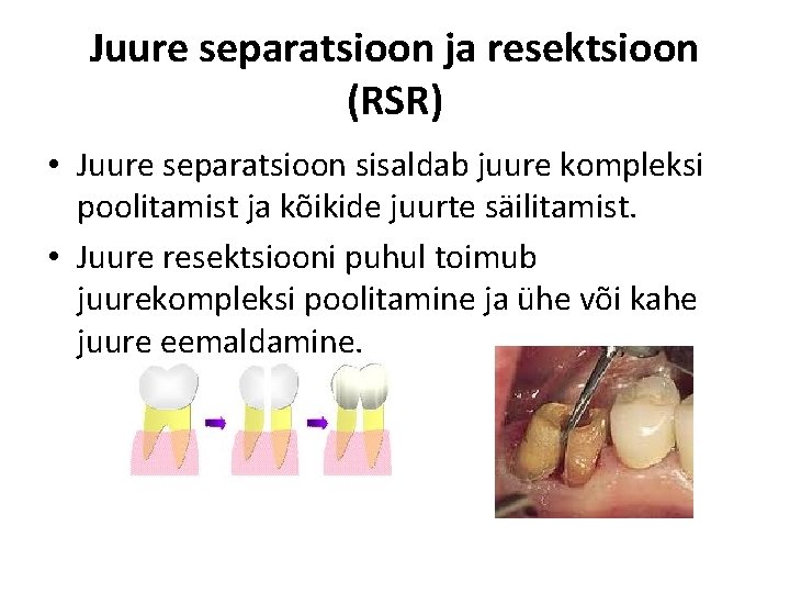 Juure separatsioon ja resektsioon (RSR) • Juure separatsioon sisaldab juure kompleksi poolitamist ja kõikide