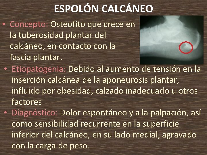 ESPOLÓN CALCÁNEO • Concepto: Osteofito que crece en la tuberosidad plantar del calcáneo, en