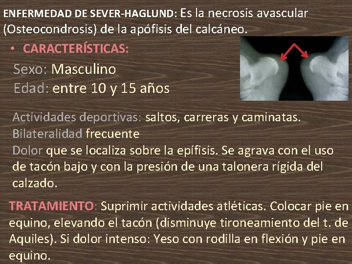 ENFERMEDAD DE SEVER-HAGLUND: Es la necrosis avascular (Osteocondrosis) de la apófisis del calcáneo. •