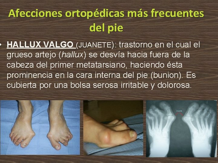 Afecciones ortopédicas más frecuentes del pie • HALLUX VALGO (JUANETE): trastorno en el cual
