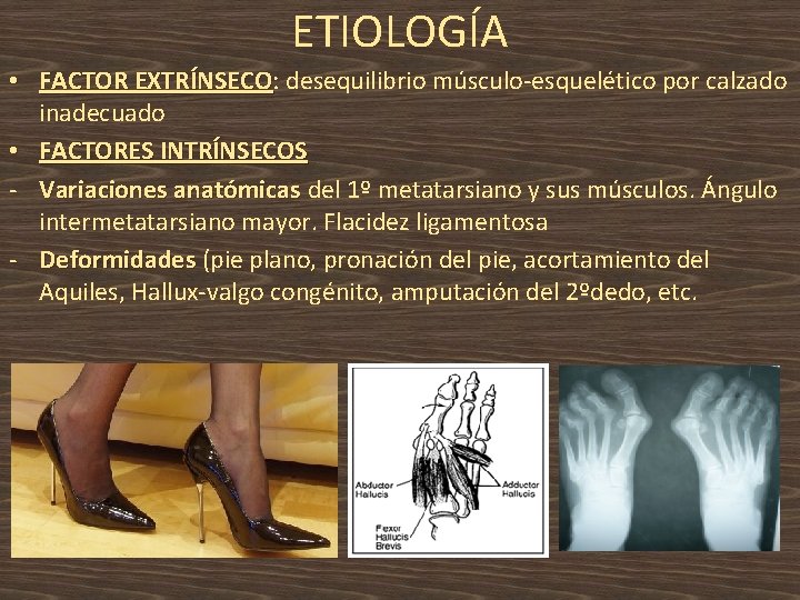 ETIOLOGÍA • FACTOR EXTRÍNSECO: desequilibrio músculo-esquelético por calzado EXTRÍNSECO inadecuado • FACTORES INTRÍNSECOS -