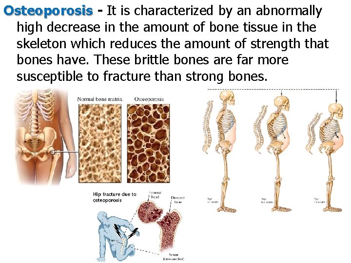 Osteoporosis - It is characterized by an abnormally high decrease in the amount of