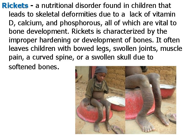 Rickets - a nutritional disorder found in children that leads to skeletal deformities due