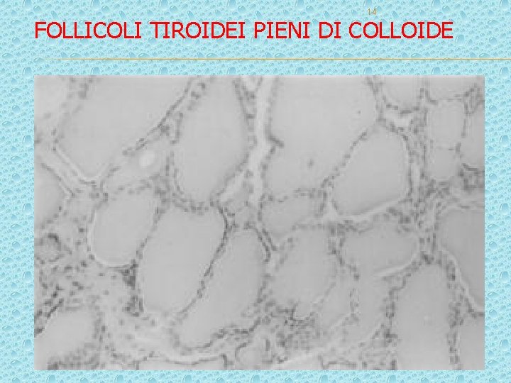 14 FOLLICOLI TIROIDEI PIENI DI COLLOIDE 14 FOLLICOLI TIROIDEI PIENI DI COLLOIDE