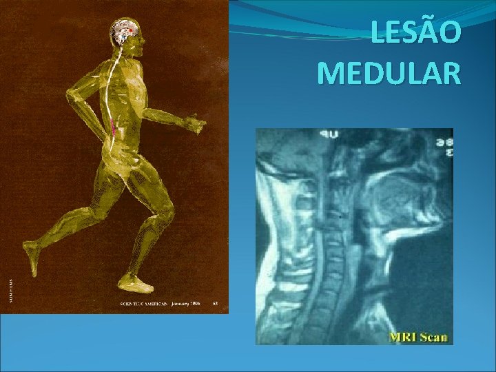 LESÃO MEDULAR LESÃO MEDULAR