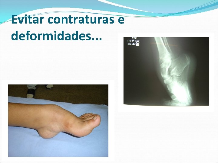 Evitar contraturas e deformidades. . . Evitar contraturas e deformidades. . .