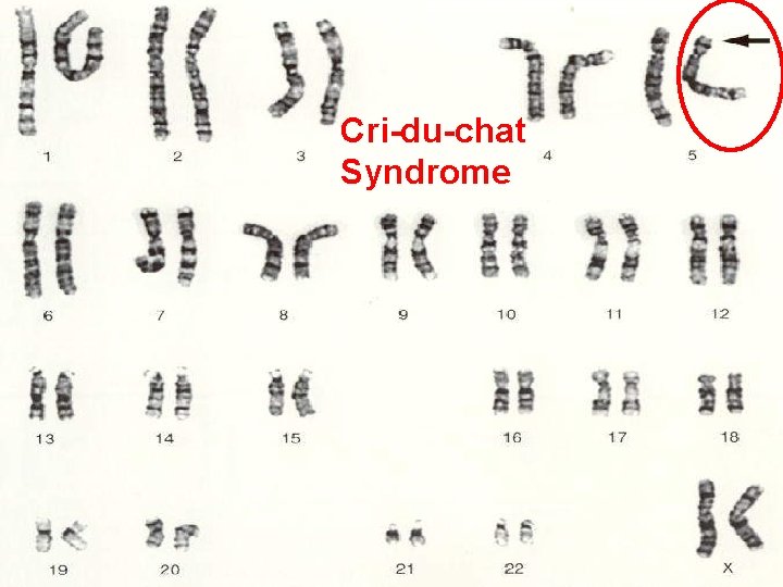 Cri-du-chat Syndrome Cri-du-chat Syndrome