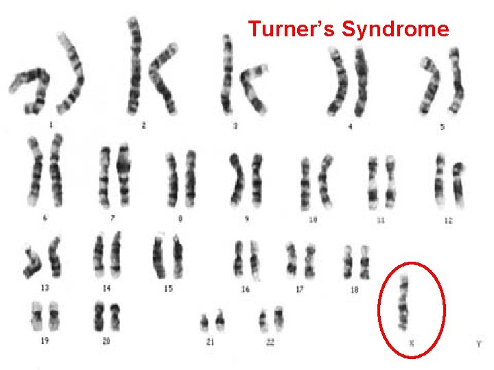 Turner’s Syndrome 