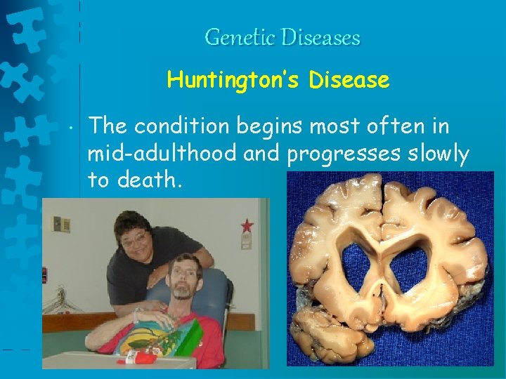Genetic Diseases Huntington’s Disease • The condition begins most often in mid-adulthood and progresses