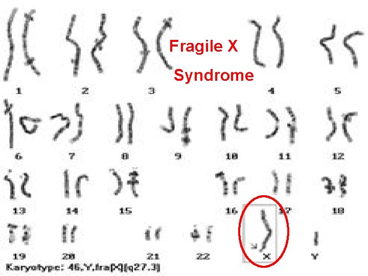 Fragile X Syndrome 