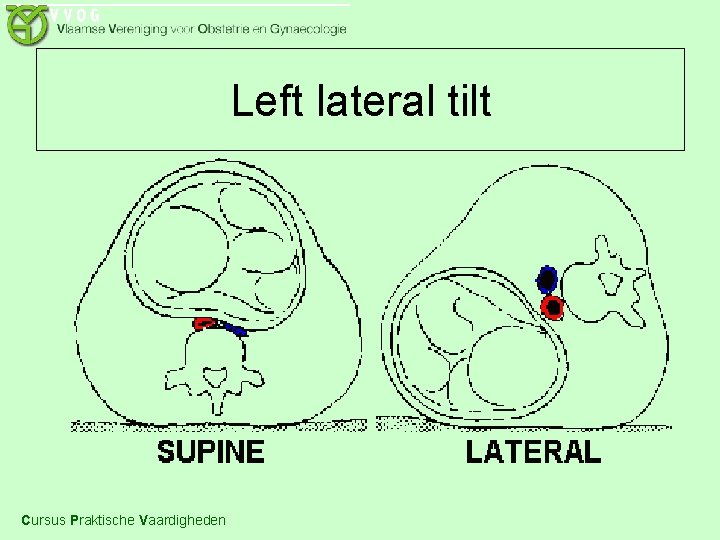 Left lateral tilt Cursus Praktische Vaardigheden 