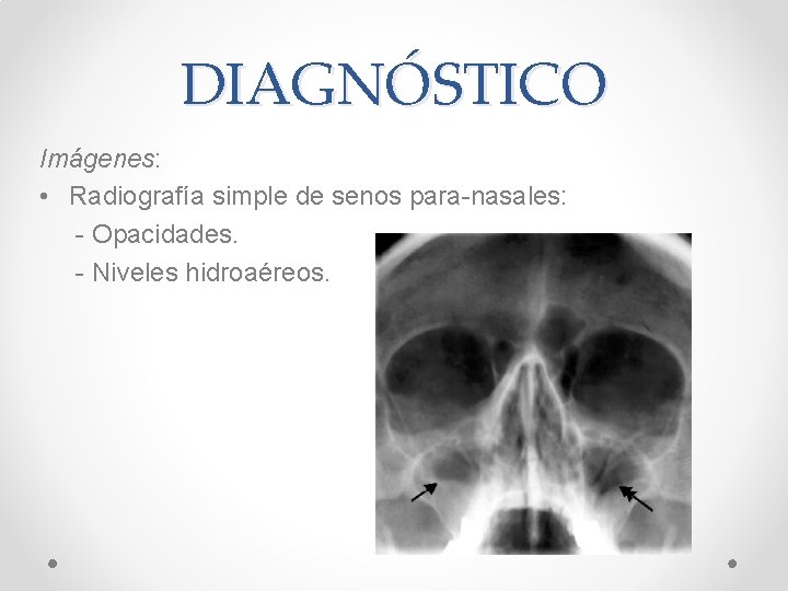 DIAGNÓSTICO Imágenes: • Radiografía simple de senos para-nasales: - Opacidades. - Niveles hidroaéreos. 