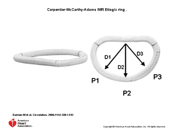 Carpentier-Mc. Carthy-Adams IMR Etlogix ring. Daimon M et al. Circulation. 2006; 114: I-588 -I-593 Carpentier-Mc. Carthy-Adams IMR Etlogix ring. Daimon M et al. Circulation. 2006; 114: I-588 -I-593
