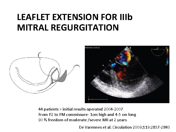 LEAFLET EXTENSION FOR IIIb MITRAL REGURGITATION 44 patients > initial results operated 2004 -2007 LEAFLET EXTENSION FOR IIIb MITRAL REGURGITATION 44 patients > initial results operated 2004 -2007