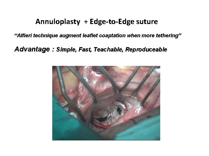 Annuloplasty + Edge-to-Edge suture “Alfieri technique augment leaflet coaptation when more tethering” Advantage : Annuloplasty + Edge-to-Edge suture “Alfieri technique augment leaflet coaptation when more tethering” Advantage :