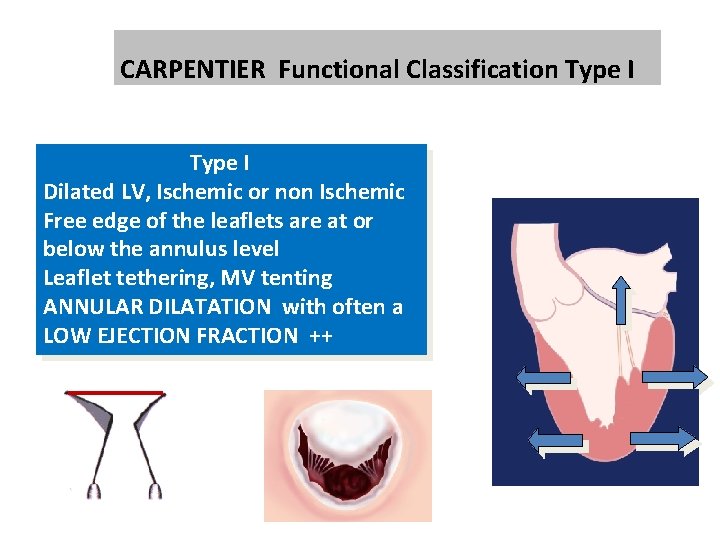 CARPENTIER Functional Classification Type I Dilated LV, Ischemic or non Ischemic Free edge of CARPENTIER Functional Classification Type I Dilated LV, Ischemic or non Ischemic Free edge of