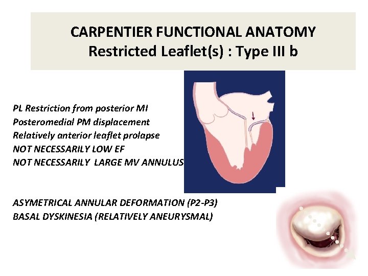 CARPENTIER FUNCTIONAL ANATOMY Restricted Leaflet(s) : Type III b PL Restriction from posterior MI CARPENTIER FUNCTIONAL ANATOMY Restricted Leaflet(s) : Type III b PL Restriction from posterior MI
