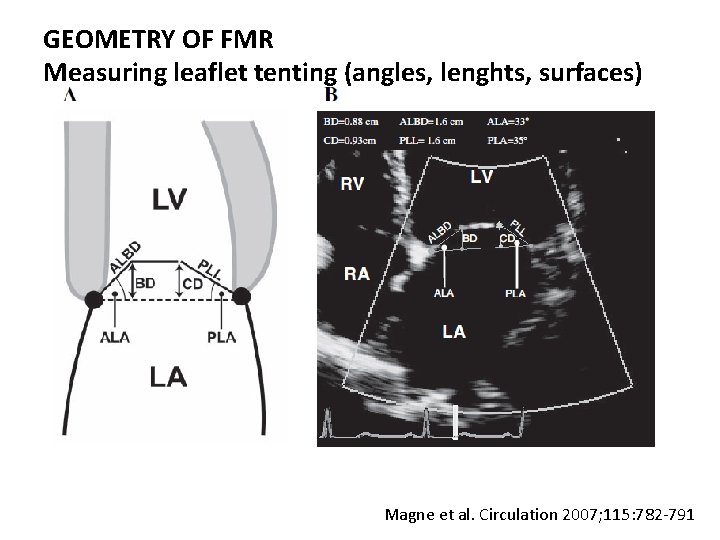 GEOMETRY OF FMR Measuring leaflet tenting (angles, lenghts, surfaces) Magne et al. Circulation 2007; GEOMETRY OF FMR Measuring leaflet tenting (angles, lenghts, surfaces) Magne et al. Circulation 2007;