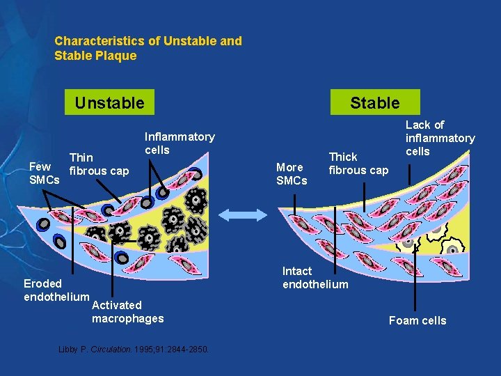 Characteristics of Unstable and Stable Plaque Unstable Few SMCs Thin fibrous cap Eroded endothelium Characteristics of Unstable and Stable Plaque Unstable Few SMCs Thin fibrous cap Eroded endothelium