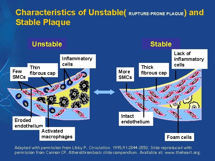 Characteristics of Unstable( RUPTURE-PRONE PLAQUE) and Stable Plaque Unstable Few SMCs Thin fibrous cap Characteristics of Unstable( RUPTURE-PRONE PLAQUE) and Stable Plaque Unstable Few SMCs Thin fibrous cap