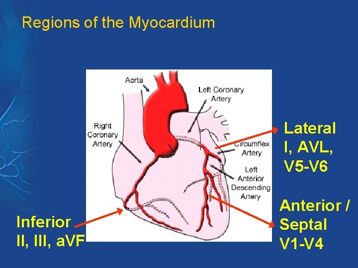 Regions of the Myocardium Lateral I, AVL, V 5 -V 6 Inferior II, III, Regions of the Myocardium Lateral I, AVL, V 5 -V 6 Inferior II, III,