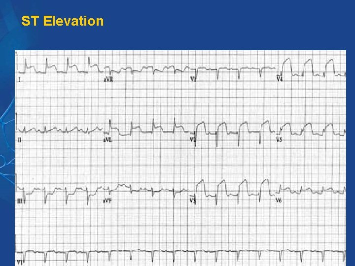 ST Elevation ST Elevation