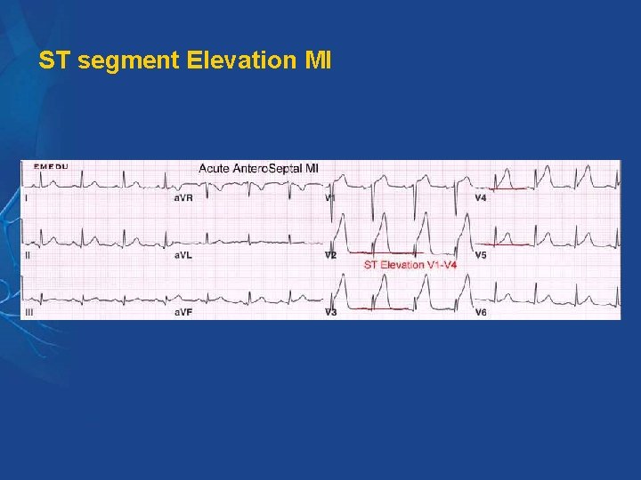 ST segment Elevation MI ST segment Elevation MI