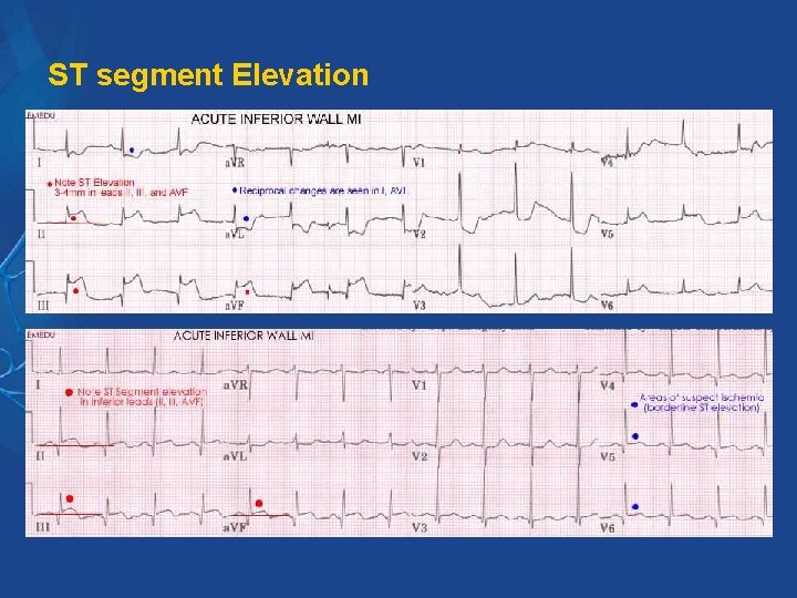 ST segment Elevation ST segment Elevation
