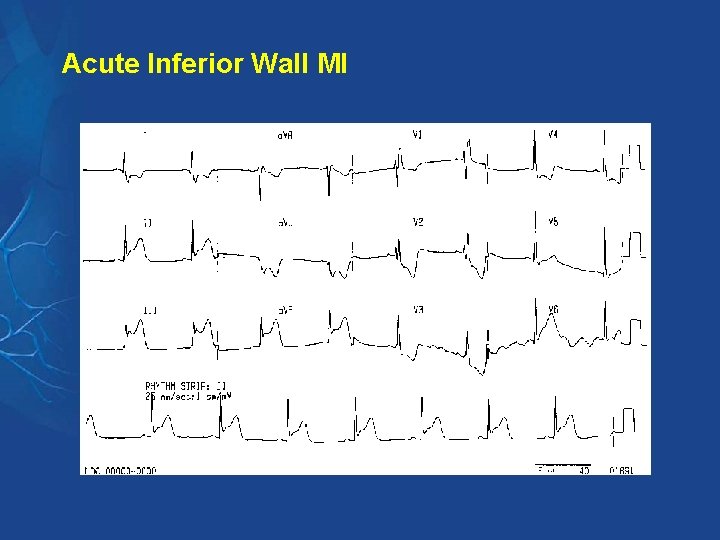 Acute Inferior Wall MI Acute Inferior Wall MI