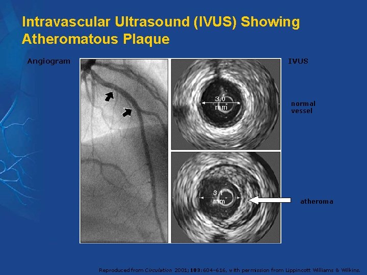 Intravascular Ultrasound (IVUS) Showing Atheromatous Plaque Angiogram IVUS normal vessel atheroma Reproduced from Circulation Intravascular Ultrasound (IVUS) Showing Atheromatous Plaque Angiogram IVUS normal vessel atheroma Reproduced from Circulation